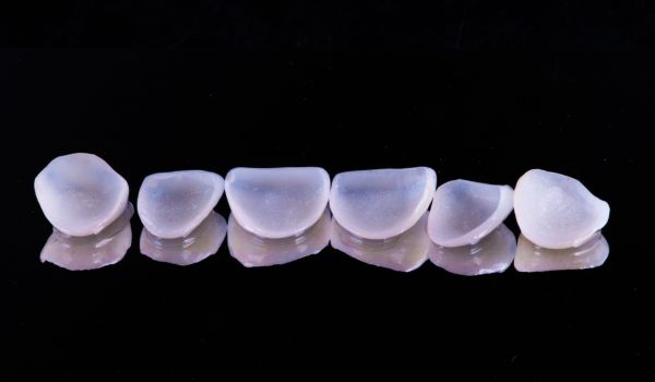 Jak vypadají zubní fazety?